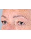 After Hair Transplant&nbsp;Eyebrows