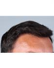 After Hair Transplant&nbsp;Front