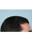 After Hair Transplant&nbsp;Front