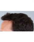 After Hair Transplant&nbsp;Hairlines
