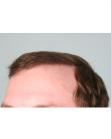 After Hair Transplant&nbsp;Hairlines