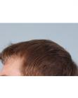 After Hair Transplant&nbsp;Hairlines