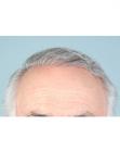 After Hair Transplant &nbsp;Hairlines