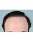 After Hair Transplant &nbsp;Revision