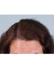 After Hair Transplant &nbsp;Hair Thinning