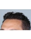 After Hair Transplant&nbsp;Front