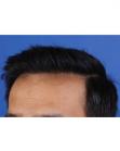 After Hair Transplant&nbsp;Front