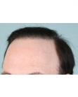 After Hair Transplant&nbsp;Revision
