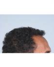 After Hair Transplant&nbsp;Hairlines