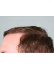 After Hair Transplant&nbsp;Hairlines