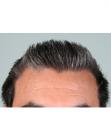 After Hair Transplant &nbsp;Temporal Hairline