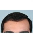 After Hair Transplant &nbsp;Front