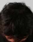 After Hair Transplant&nbsp;Crown