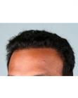 After Hair Transplant&nbsp;Hairlines