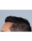 After Hair Transplant&nbsp;Front