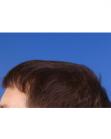 After Hair Transplant&nbsp;Front