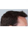 After Hair Transplant&nbsp;Hairlines