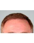 After Hair Transplant &nbsp;Front