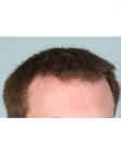 After Hair Transplant&nbsp;Front