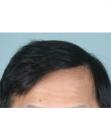 After Hair Transplant &nbsp;2 Sessions (Areas)