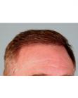 After Hair Transplant&nbsp;Front