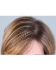 After Hair Transplant &nbsp;Hair Thinning