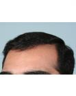 After Hair Transplant&nbsp;Front