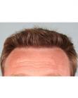 After Hair Transplant &nbsp;Hairlines