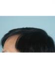 After Hair Transplant&nbsp;2 Sessions (Areas)