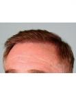 After Hair Transplant&nbsp;Front