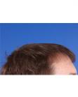 After Hair Transplant&nbsp;Front