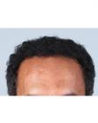 After Hair Transplant &nbsp;Hairlines