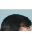 After Hair Transplant&nbsp;2 Sessions (Areas)