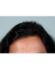 After Hair Transplant &nbsp;Hair Thinning