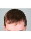 After Hair Transplant&nbsp;Hairlines