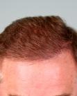 After Hair Transplant&nbsp;Front