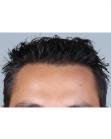 After Hair Transplant &nbsp;Front