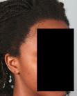 After Hair Transplant&nbsp;Traction Alopecia