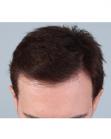 After Hair Transplant&nbsp;Front