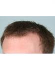 After Hair Transplant&nbsp;Front