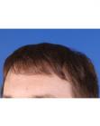 After Hair Transplant&nbsp;Front