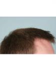 After Hair Transplant&nbsp;Front