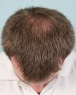 After Hair Transplant&nbsp;Front