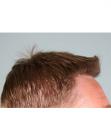 After Hair Transplant&nbsp;Hairlines