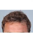 After Hair Transplant &nbsp;Hairlines