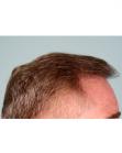 After Hair Transplant&nbsp;Front