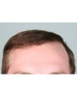 After Hair Transplant &nbsp;Hairlines