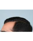 After Hair Transplant&nbsp;Front