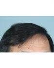 After Hair Transplant&nbsp;2 Sessions (Areas)