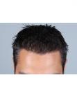 After Hair Transplant&nbsp;Front